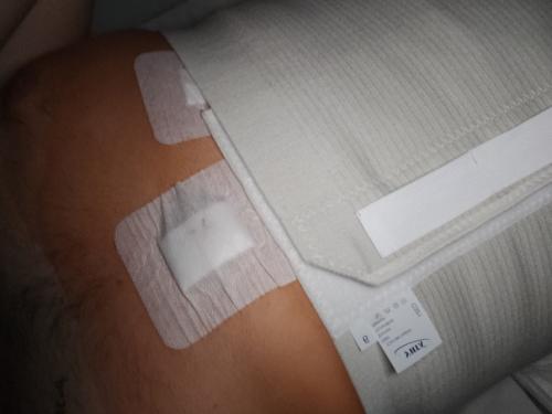 Обзор на камни в желчном пузыре, операцию по его удалению и жизнь после. 01