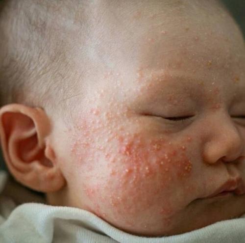 Детские сыпи. Акне новорождённых. 05 Детские сыпи. Акне новорождённых. 05