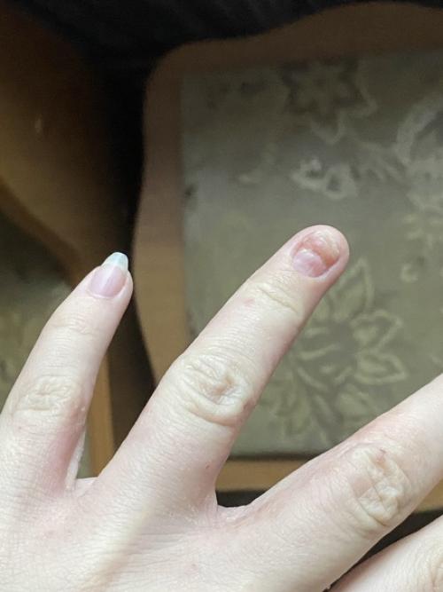 В Самаре у женщины начали шелушиться руки и слова врача её потрясли. 01