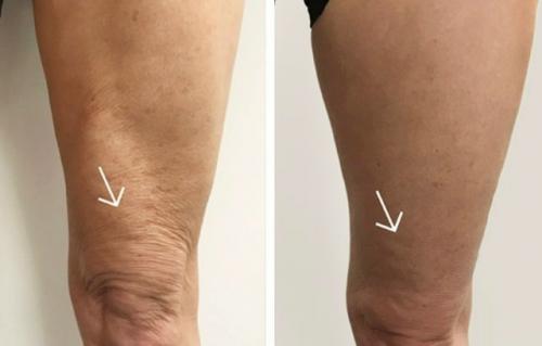 Вакуумно - роликовый массаж с RF лифтингом и инфракрасным светом. 01