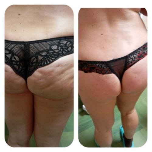 Вакуумно - роликовый массаж с RF лифтингом и инфракрасным светом. 04