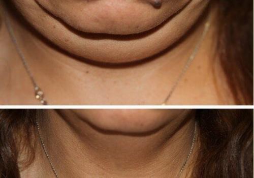 Инъекционное липомоделирование лица. 01