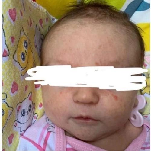 Типичная ситуация:  На приеме ребенок второго месяца с прыщами на лице. 01 Типичная ситуация:  На приеме ребенок второго месяца с прыщами на лице. 01