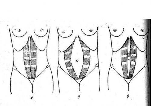Диета при диастазе. Диастаз у женщин.