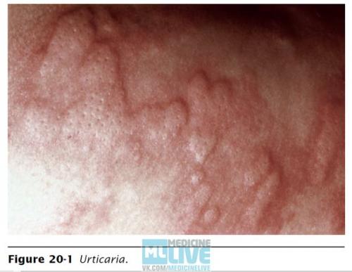 Крапивница (ангионевротический отек квинке). 01 Крапивница (ангионевротический отек квинке). 01