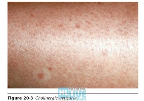 Крапивница (ангионевротический отек квинке). 02 Крапивница (ангионевротический отек квинке). 02