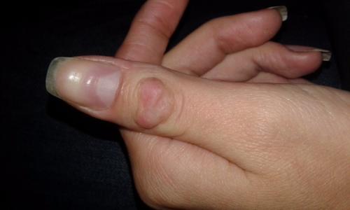 На пальце шишка на суставе. Лечение народными средствами 03 На пальце шишка на суставе. Лечение народными средствами 03