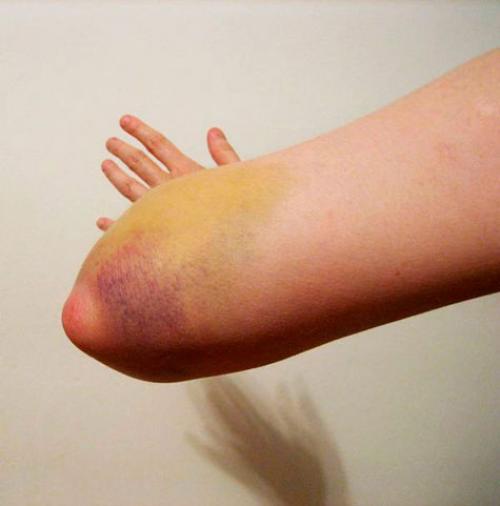 Ударила локоть болит при сгибании. Обзор ушиба локтевого сустава: виды, степени, симптомы и лечение