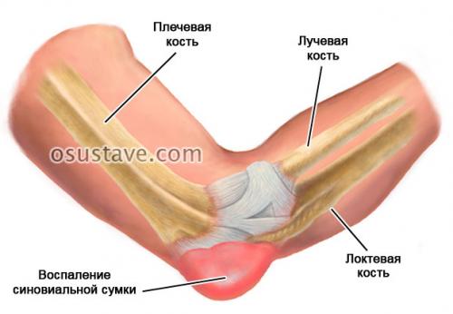 Ударила локоть болит при сгибании. Обзор ушиба локтевого сустава: виды, степени, симптомы и лечение
