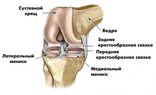 Застарелое повреждение мениска коленного сустава. Симптомы повреждения мениска