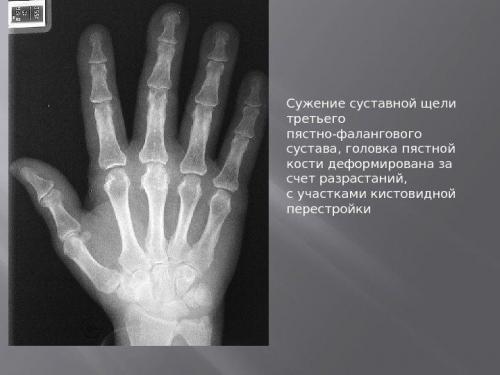 Деформирующий остеоартроз кистей рук. Правильное лечение деформирующего артроза кистей рук