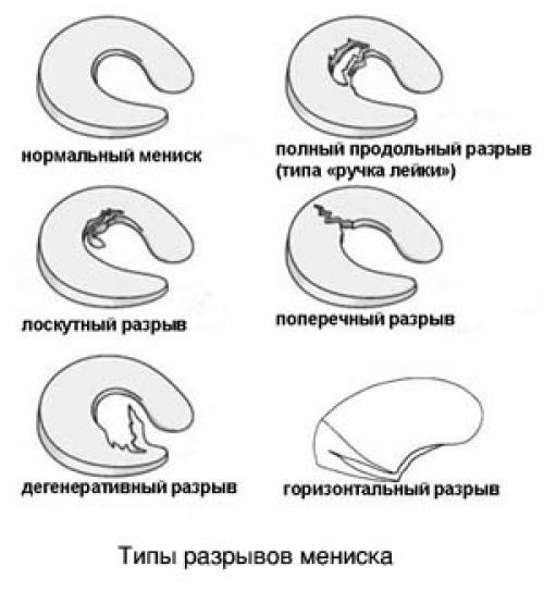 Сколько менисков в коленном суставе. Строение и функции мениска 12