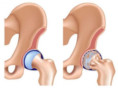 Рентген дисплазия тазобедренного сустава. Какие болезни и травмы выявляет исследование