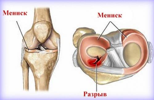 Частичный разрыв мениска коленного сустава. Что такое разрыв?