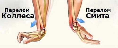 Хрустит запястье при вращении. Хруст в запястье 02