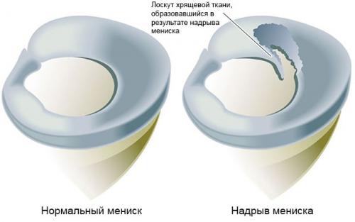 Сколько менисков в коленях. Что такое мениск коленного сустава, возможные повреждения, их причины и лечение