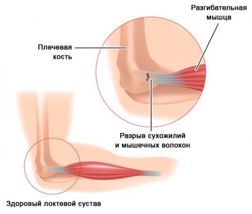Травмы локтевого сустава при падении на прямую руку. Обзор ушиба локтевого сустава: виды, степени, симптомы и лечение
