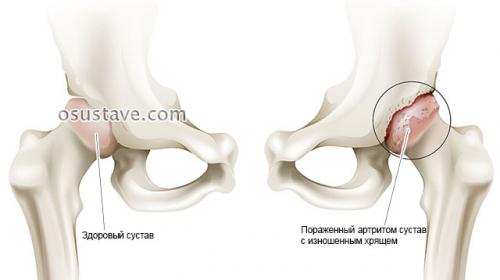 Ноющая боль в тазобедренном суставе в покое. Патологии, вызывающие боли в тазобедренном суставе