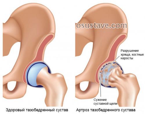 Ноющая боль в тазобедренном суставе в покое. Патологии, вызывающие боли в тазобедренном суставе