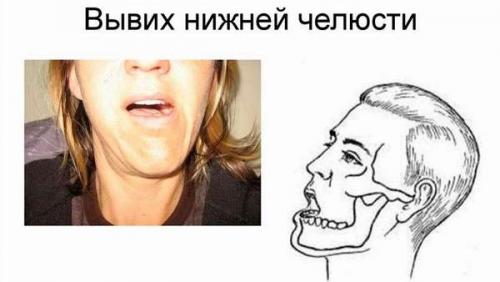 Как определить вывих челюсти. Причины подвывихов и вывихов челюстного сустава