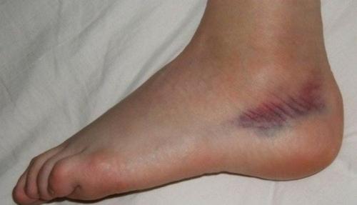 Растяжение связок голеностопного сустава лечение. Растяжение связок голеностопного сустава: лечение, причины, симптомы, полное описание травмы