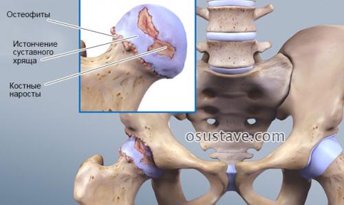 Ноющая боль в тазобедренном суставе в покое. Патологии, вызывающие боли в тазобедренном суставе