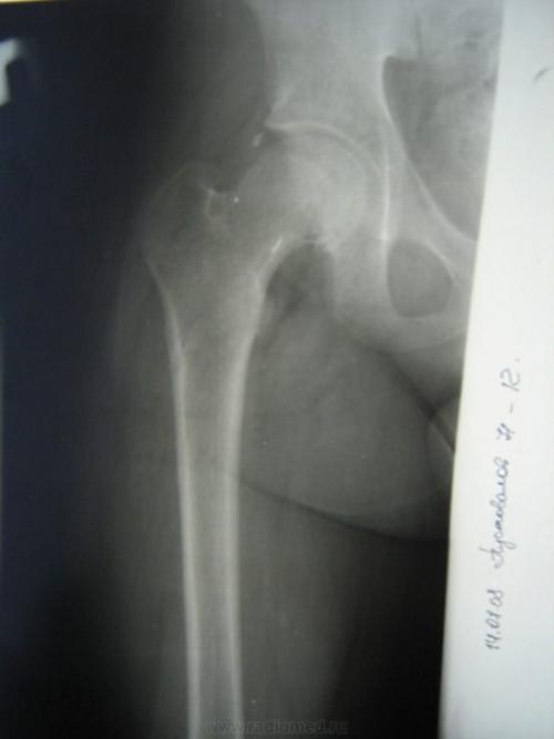 Ноющая боль в тазобедренном суставе ночью. Причины появления боли в тазобедренном суставе ночью лежа на боку, сопутствующая симптоматика