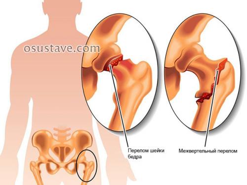 Ноющая боль в тазобедренном суставе в покое. Патологии, вызывающие боли в тазобедренном суставе