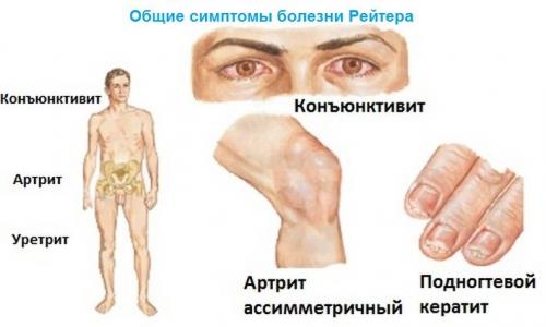 Как избавиться от боли в тазобедренном суставе. Почему болит тазобедренный сустав: причины, что делать, как лечить
