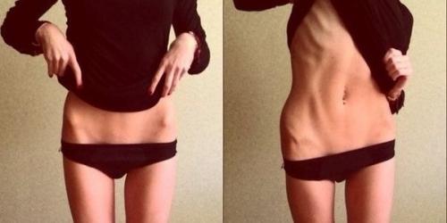 Диета для анорексичек на 14 дней. Диеты анорексичек: для начинающих, питьевая и для ног