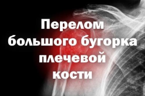 Срастание перелома бугорка плечевой кости. Перелом большого бугорка плечевой кости