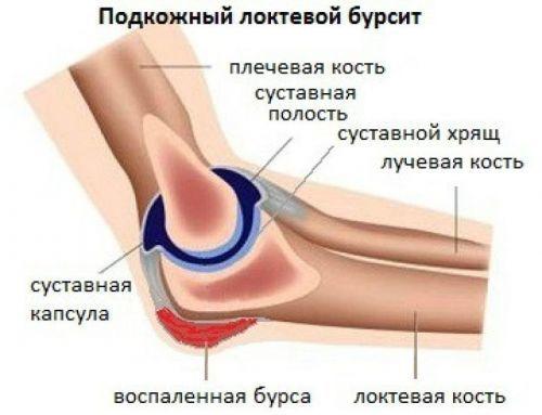 Боль в локтевом суставе при поднятии тяжести. Эпикондилит