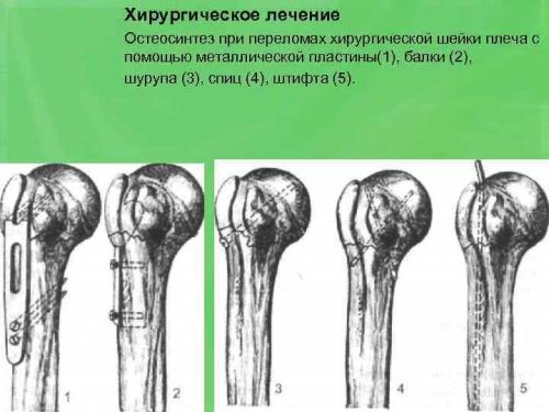 Перелом плечевой кости сроки восстановления. Способы, как лечить перелом плечевой кости и трудности которые могут возникнуть