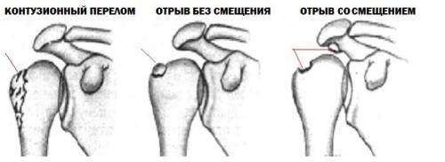 Срастание перелома бугорка плечевой кости. Перелом большого бугорка плечевой кости