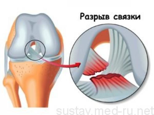 Разрыв связок на ноге. Что такое связки и как от личить разрыв связок от растяжения
