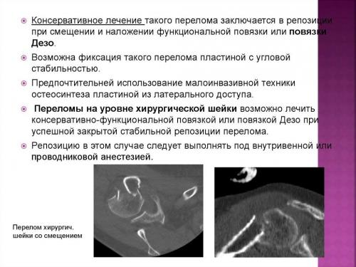 Перелом плечевой кости сроки восстановления. Способы, как лечить перелом плечевой кости и трудности которые могут возникнуть