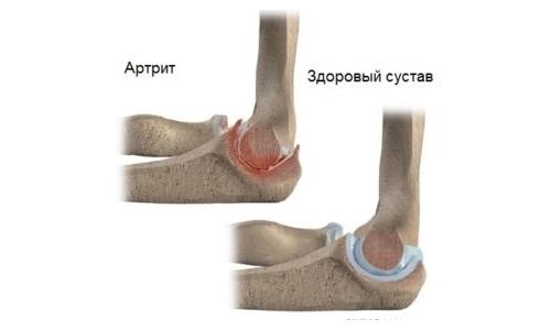 Боль в локтевом суставе с внутренней стороны. Возможные заболевания