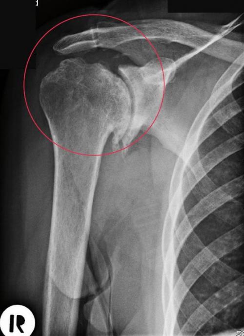 У ребенка щелкает плечевой сустав. Остеоартроз