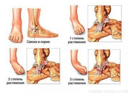 Разрыв связок на ноге. Что такое связки и как от личить разрыв связок от растяжения