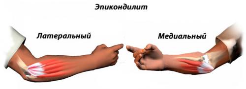 Болит локоть при полном разгибании. Основные причины