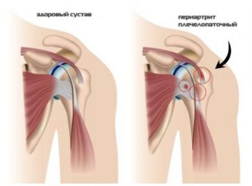 Плечо болит и хрустит при поднятии. Почему болит и хрустит плечо?