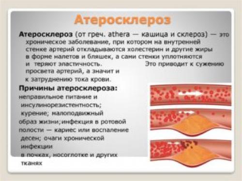 Заболевания подвздошной артерии. Внутренняя подвздошная артерия и ее ветви