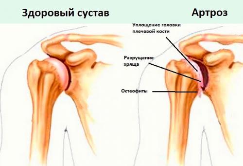 Плечо болит и хрустит при поднятии. Почему болит и хрустит плечо?