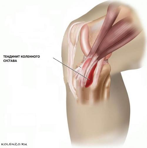 Коленная чашечка. Почему болит коленная чашечка: причины, симптомы, лечение