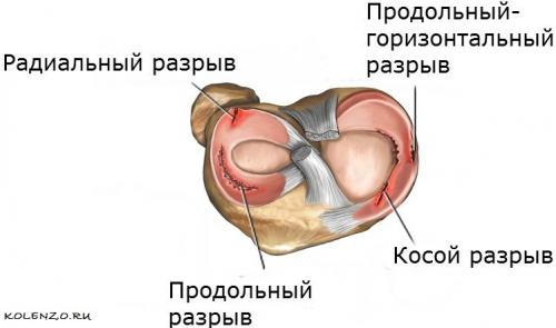 Коленная чашечка. Почему болит коленная чашечка: причины, симптомы, лечение