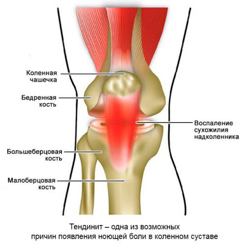 Горячие колени и ноют. Самые частые причины ноющей боли в коленях, что делать, лечение