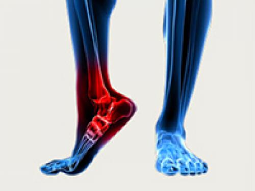 Как лечить артроз руки. Стадии болезни и их симптомы 03