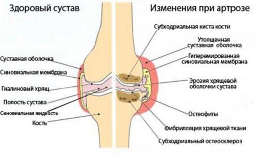 Двусторонний гонартроз 3 степени инвалидность. Возможно ли лечение гонартроза факторы сустава 3 степени и почему внутренние инвалидность