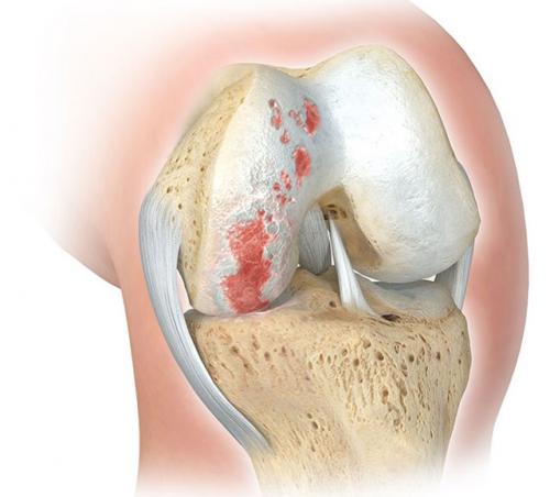 Коленная чашечка. Почему болит коленная чашечка: причины, симптомы, лечение
