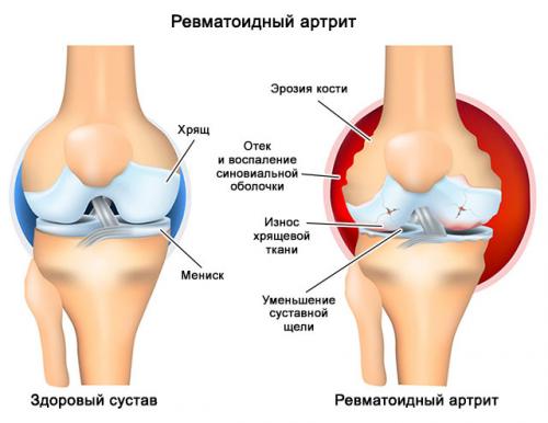 Горячие колени и ноют. Самые частые причины ноющей боли в коленях, что делать, лечение